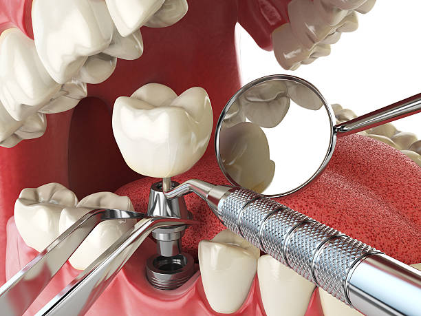 Best Broken or Chipped Tooth Repair in Palmdale, CA